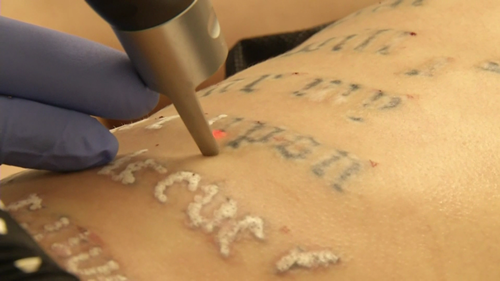 Does Laser Tattoo Removal help Remove Tattoo