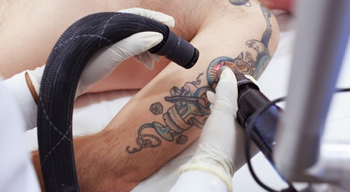 Facts about Tattoo Removal Market