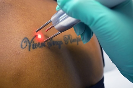 Things Everyone Should Know About Tattoo Removal